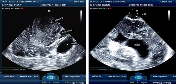 左圖顯示術(shù)中超聲見囊實性病變，大小約為4x4x3cm，病灶周圍腦組織水腫明顯；右圖為病灶切除后，術(shù)中超聲示術(shù)腔無病變殘留