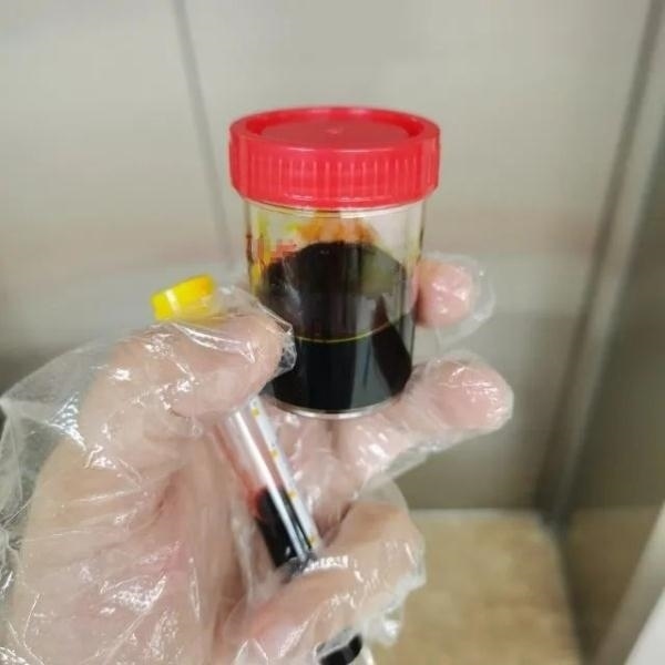 急性肝衰竭！兩兄弟誤吃這種菌 專家提醒