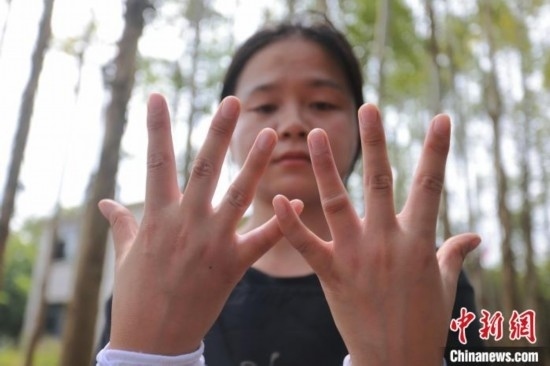 吳素英展示被蜜蜂蜇過的雙手。湯曉逵 攝