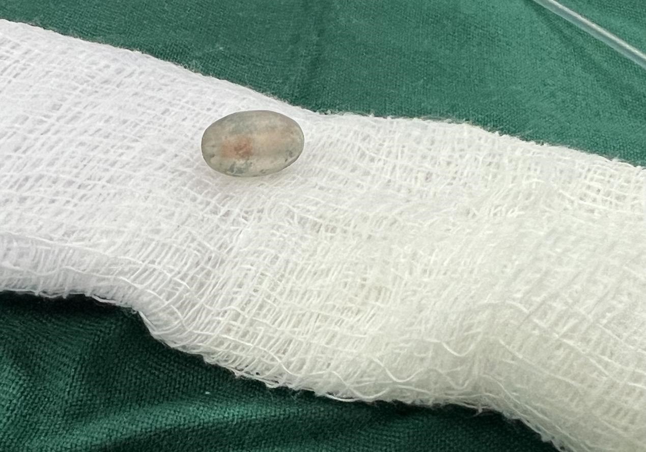 被取出的異物。中國(guó)援桑醫(yī)療隊(duì)供圖