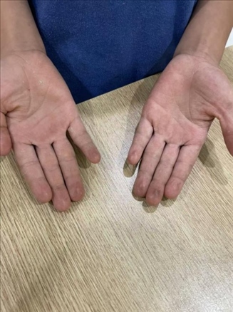 9歲小學(xué)生長期拍煙卡，手部粗糙長繭。受訪者供圖